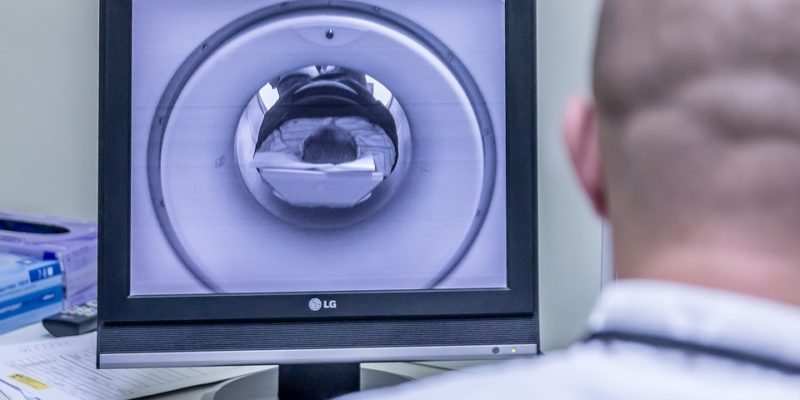 TMS, magnetische hersenstimulatie, stemmingsstoornissen , autisme, antisociaal gedrag, MRI-scan, hersenscan, wetenschappers, ECT, onderzoek, obesitas, deep brainstimulation, diepe hersenstimulatie