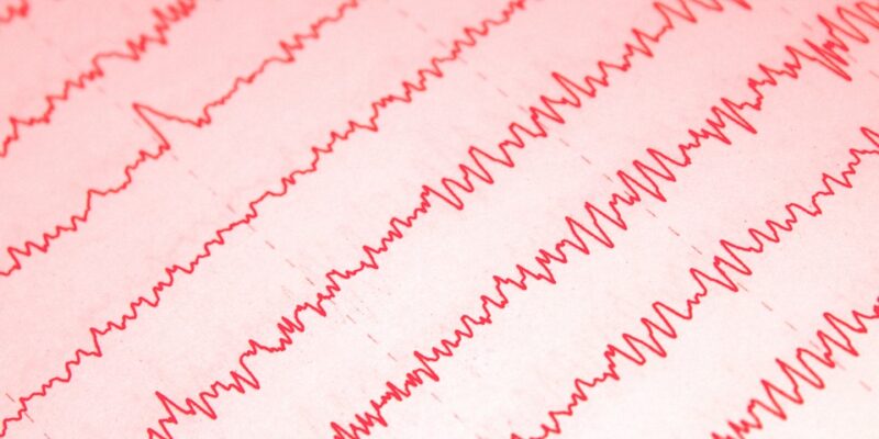 EEG, autisme, mentale vaardigheden, Gilles de la Tourettes, EEG, TMS, OCD, hersenactiviteit